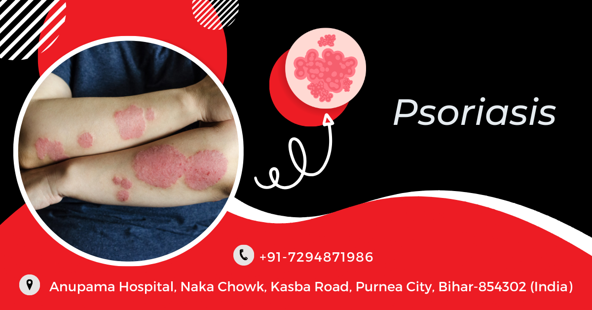 Autoimmune Diseases - Psoriasis